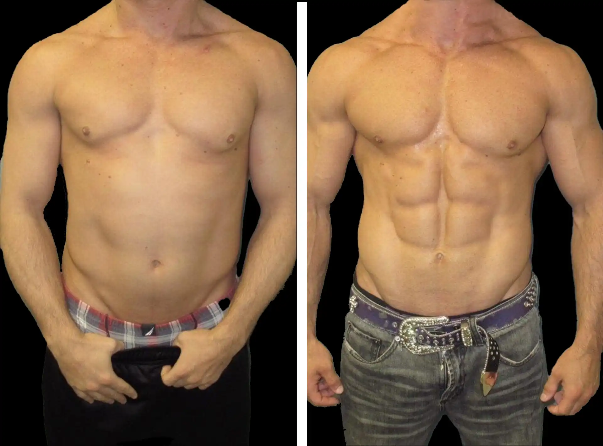 Body Contouring before and after